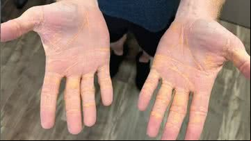 Nódulos em mãos de homem com dieta rica em gordura - Reprodução/Journal of the American Medical Association