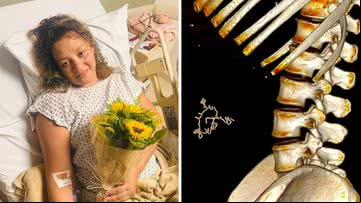 Tatiane dos Santos após cirurgia; tomografia mostra o objeto estranho no abdômen - Reprodução/Arquivo Pessoal