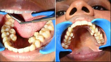 Kalpana Balan possui seis dentes a mais do que a maioria das pessoas - Divulgação/Guinness World Records